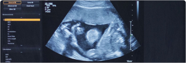 Ultrassonografia obstétrica no primeiro trimestre da gestação (11 a 14 semanas).