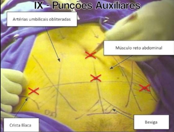 Histerectomia laparoscópica (retirada do útero) - Dra. Raquel Lima