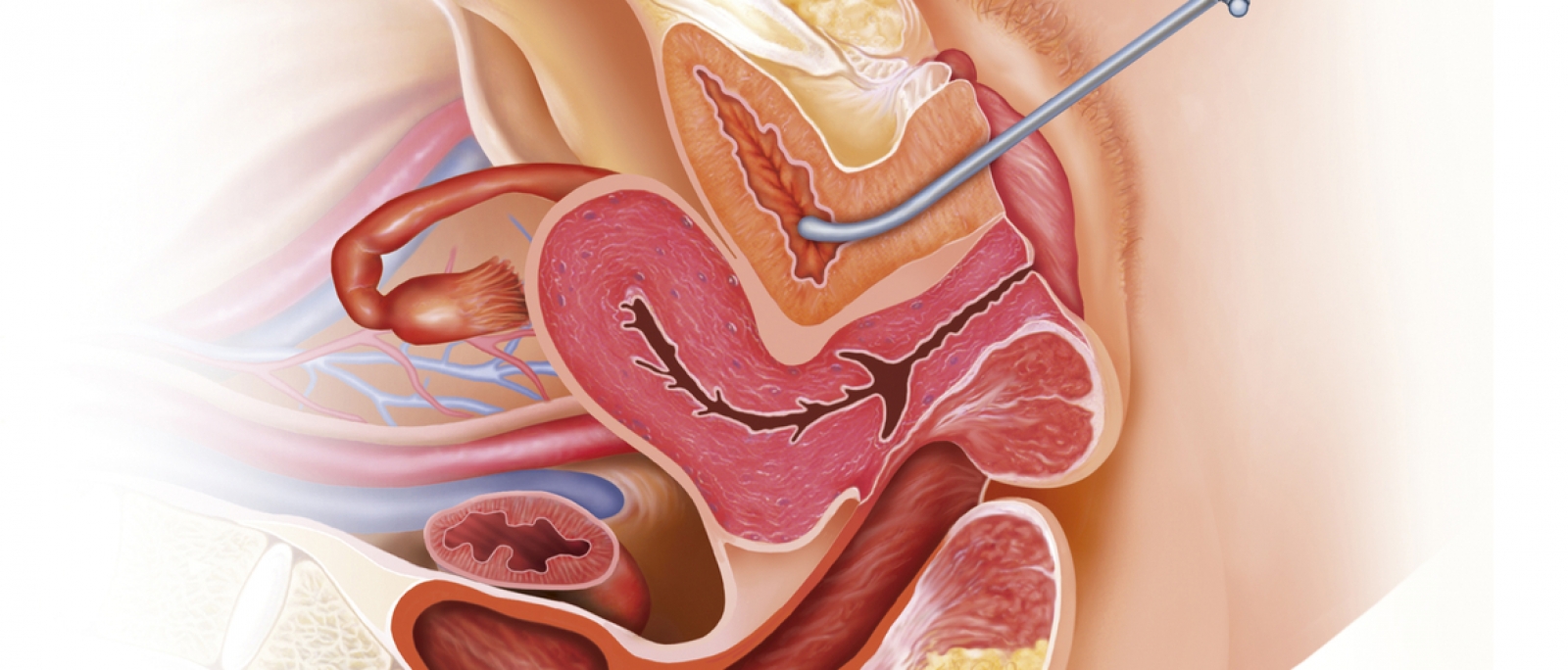 prostatita visculita