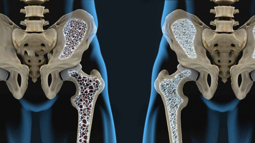 Dia Mundial e Nacional de combate à Osteoporose