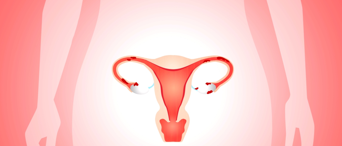 Endometriose Parametrial