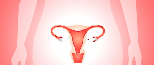 Endometriose Parametrial