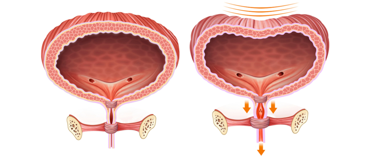 PROTOCOLO sobre incontinência urinária de esforço