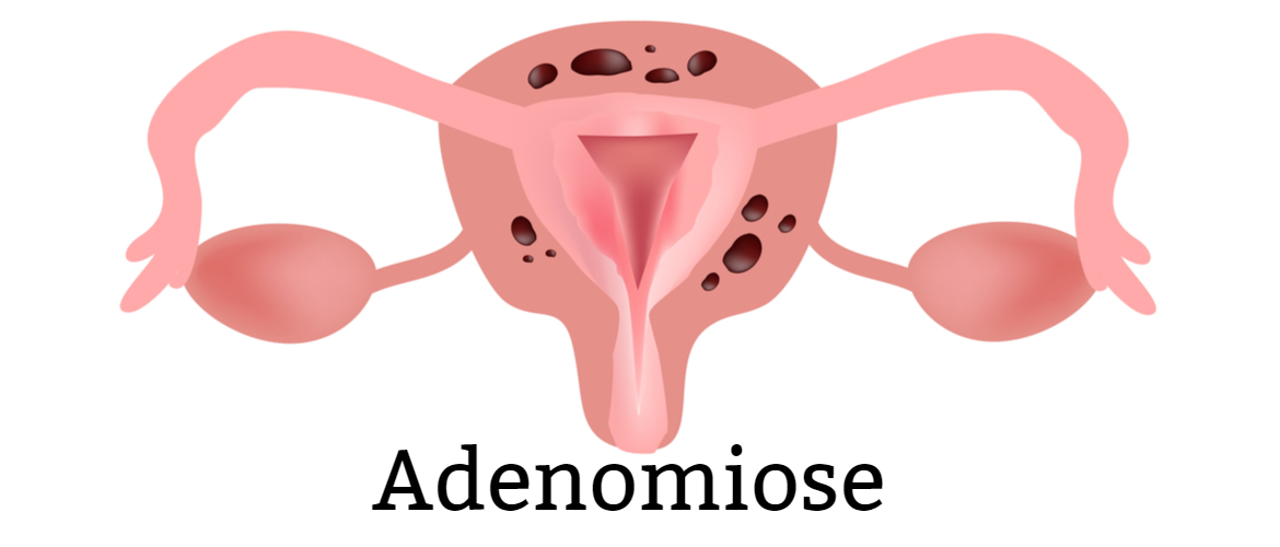 Adenomiose: Quadro clínico e diagnóstico