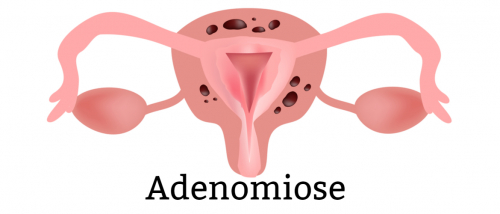 Adenomiose: Quadro clínico e diagnóstico