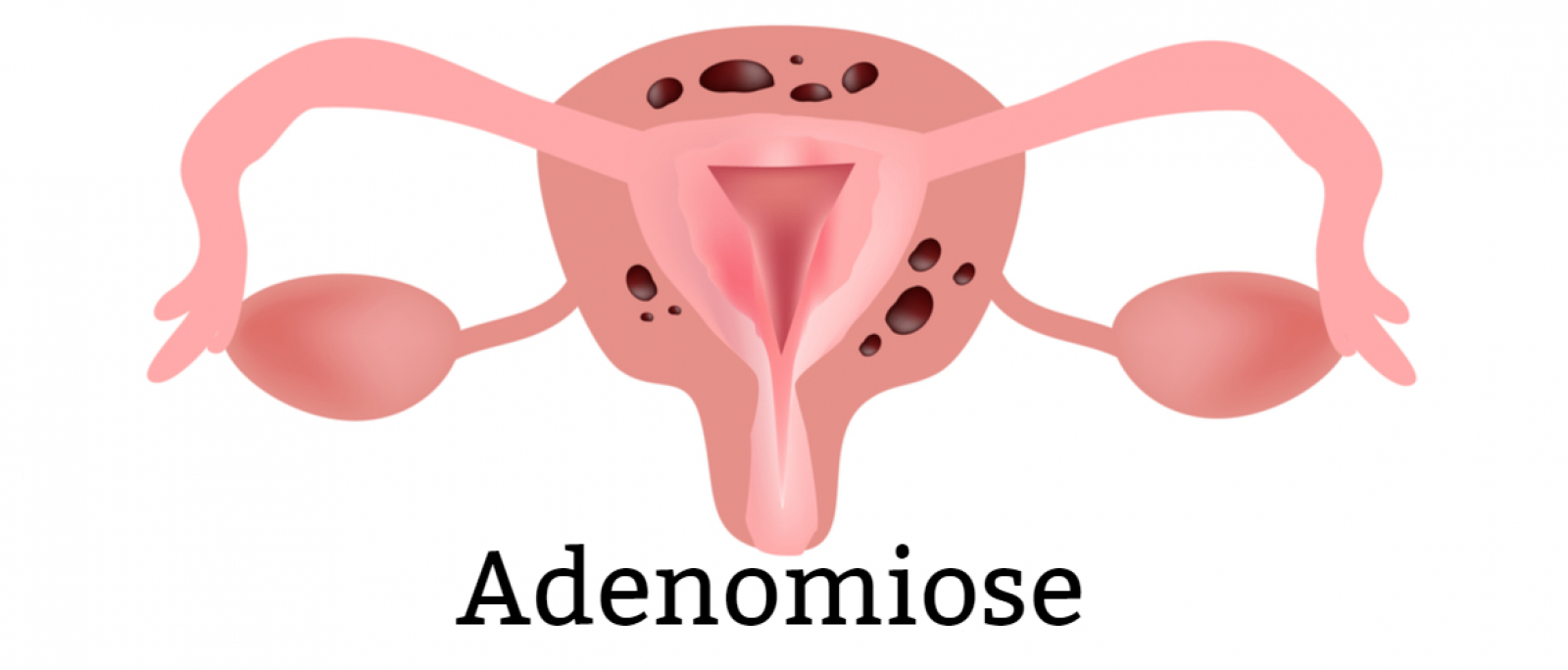 Adenomiose: conheça os sintomas