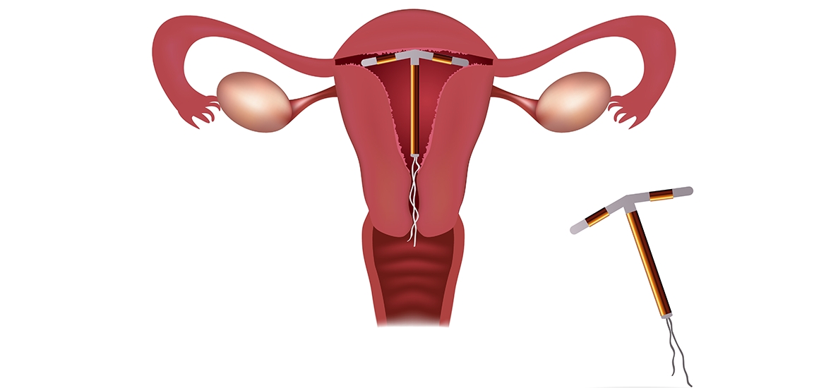 Dispositivo intrauterino: de onde viemos e onde chegamos