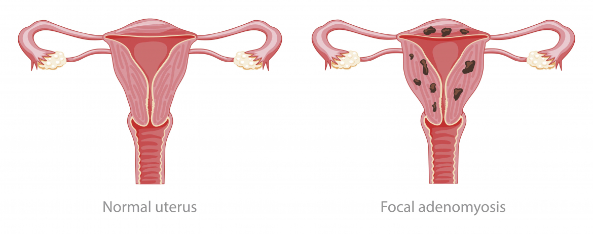 Pouco investimento em pesquisa interfere no tratamento da adenomiose, analisa especialista da FEBRASGO