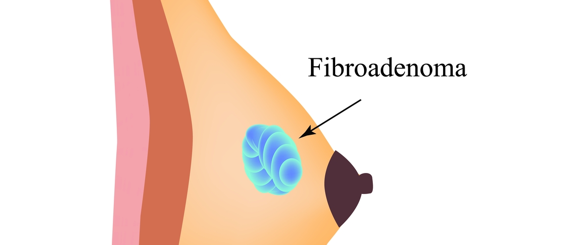 Fibroadenoma