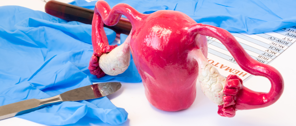 Endometrioma de ovário, quando e como realizar tratamento cirúrgico?