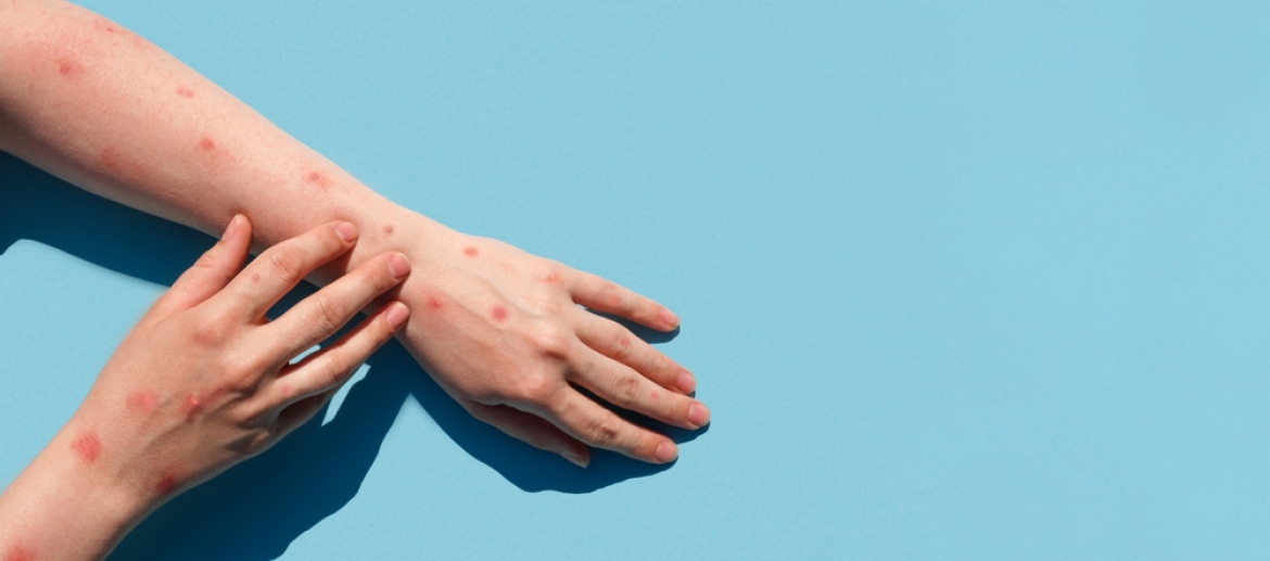 Monkeypox ou Varíola do Macaco e atendimentos em Clínicas de Reprodução – Atenção e Cuidados